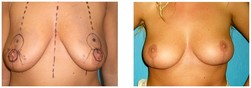 Zmniejszenie piersi przed i po zabiegu