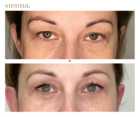 Operacje plastyczne powiek przed i po zabiegu