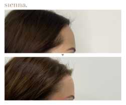Chirurgiczne obniżenie linii włosów