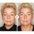 Modelowanie twarzy, wypełnienia zmarszczek preparatem Radiesse przed i po zabiegu