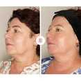 Modelowanie twarzy, wypełnienia zmarszczek preparatem Radiesse przed i po zabiegu