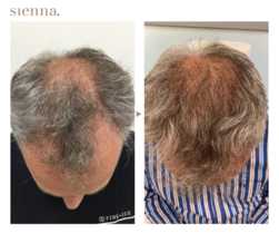 Przeszczep włosów FUE u mężczyzn przed i po zabiegu