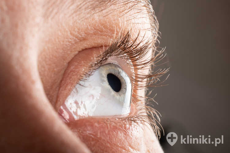 Leczenie stożka rogówki