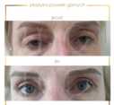 Plastyka chirurgiczna powiek górnych przed i po zabiegu