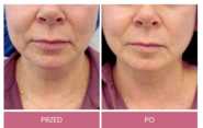 Lifting operacyjny przed i po zabiegu