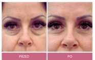 Operacje plastyczne powiek przed i po zabiegu