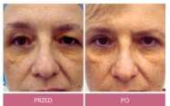 Operacje plastyczne powiek przed i po zabiegu