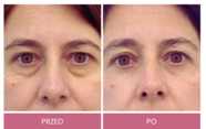Operacje plastyczne powiek przed i po zabiegu
