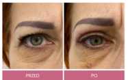 Operacje plastyczne powiek przed i po zabiegu