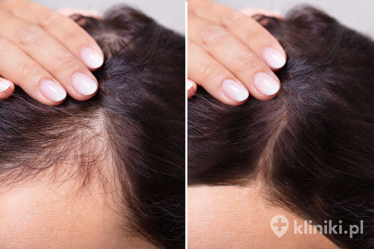 Regenera Activa polega na stymulacji mieszków włosowych do regeneracji i ponownego wzrostu włosów bez konieczności klasycznego przeszczepu