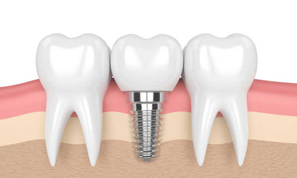 Implanty zębowe Nobel Biocare