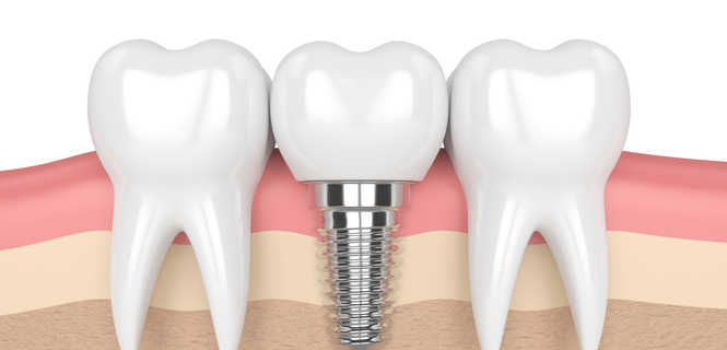 Implanty zębowe Nobel Biocare