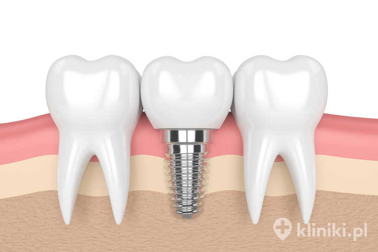 Implanty zębowe Nobel Biocare