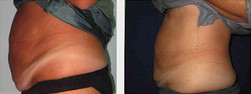 Kriolipoliza - odchudzanie brzucha przed i po zabiegu