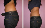 Kriolipoliza - odchudzanie / modelowanie ciała zimnem przed i po zabiegu