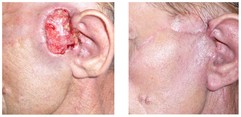 Leczenie nowotworów skóry przed i po zabiegu