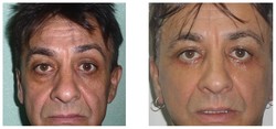 Lifting operacyjny twarzy przed i po zabiegu