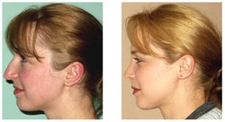 Operacja nosa kostnego przed i po zabiegu