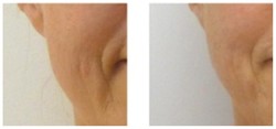 Pelleve - usuwanie zmarszczek wokół ust przed i po zabiegu