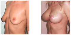 Powiększanie piersi implantami przed i po zabiegu