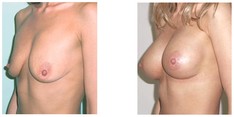 Powiększanie piersi przed i po zabiegu
