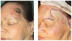 Wycięcie raka skóry przed i po zabiegu