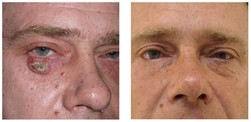 Wycięcie raka skóry przed i po zabiegu