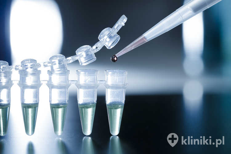 Leczenie zwyrodnienia plamki żółtej AMD komórkami macierzystymi opiera się na wykorzystaniu zdolności regeneracyjnych komórek do wspierania funkcji nabłonka barwnikowego siatkówki