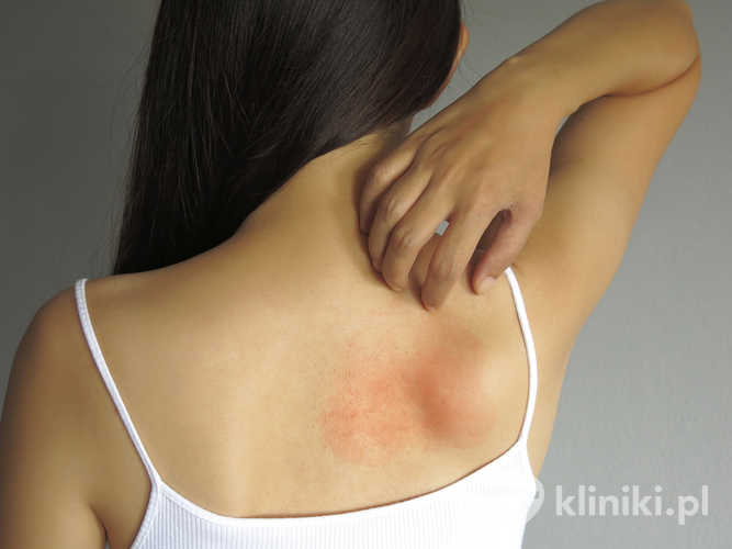 Terapia ran i oparzeń z użyciem komórek macierzystych wspiera odbudowę skóry poprzez stymulację tworzenia nowych komórek i naczyń krwionośnych