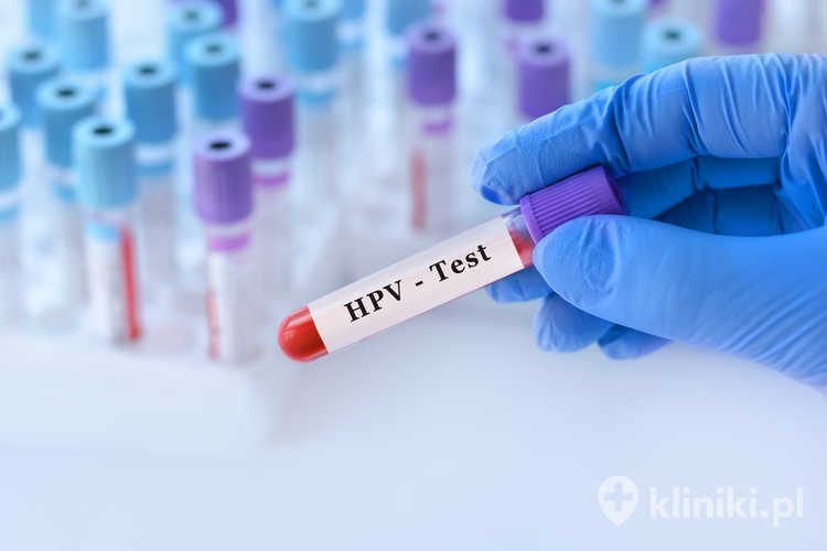 Zakażenie HPV można wcześnie wykryć dzięki badaniom przesiewowym, takim jak test HPV lub cytologia