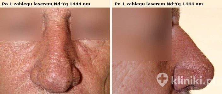 Leczenie guzowatości nosa laserem Nd:Yg - stan po 1 zabiegu