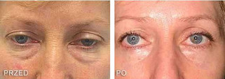 Operacje plastyczne powiek przed i po zabiegu