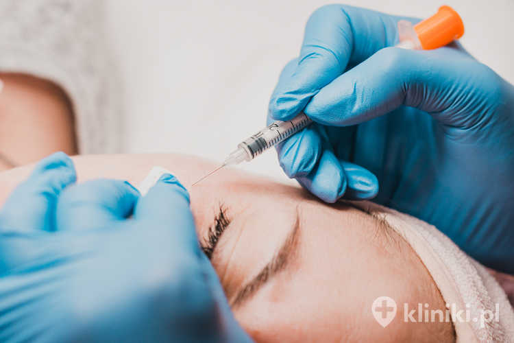 Profesjonalne usuwanie prosaków