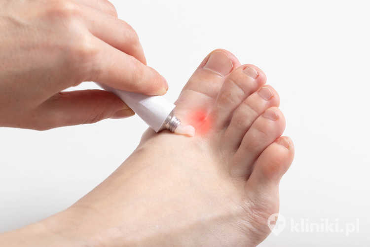 Leczenie świerzbu obejmuje odpowiednie preparaty oraz jednoczesną terapię osób z bliskiego otoczenia