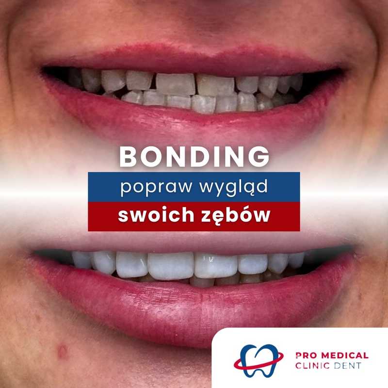 Bonding Zdj cia Przed I Po Kliniki pl bonding-zdj-cia-przed-i-po-kliniki-pl
