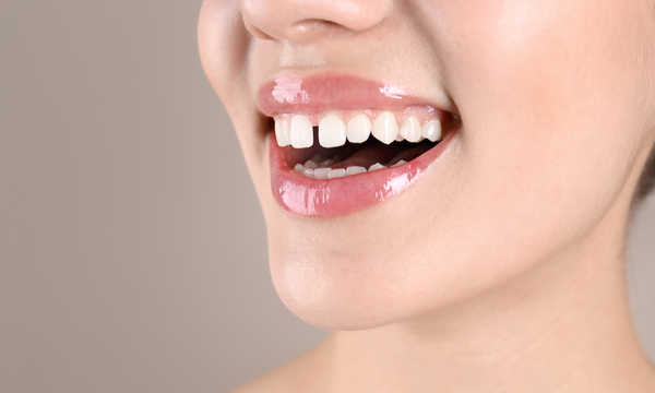 Sposoby leczenia diastemy zależą przede wszystkim od przyczyny powstania przerwy między zębami.