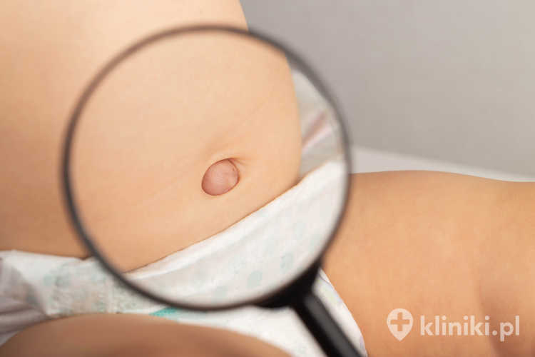 Przepuklina pępkowa