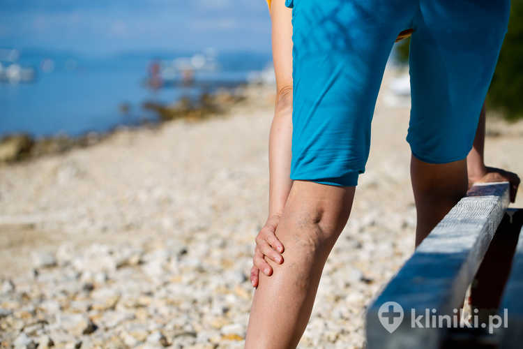 Żylaki często mają podłoże genetyczne, ale sprzyjają im także długie stanie, siedzący tryb życia i nadwaga