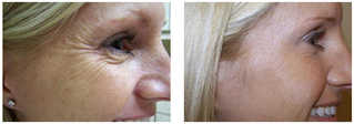 Zabiegi z użyciem botoksu przed i po zabiegu