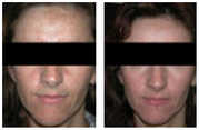 Zabiegi z użyciem botoksu przed i po zabiegu