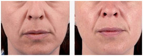 Dolina łez - usuwanie zmarszczek kwasem hialuronowym przed i po zabiegu