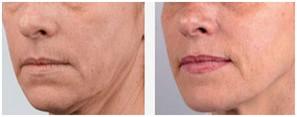 Dolina łez - usuwanie zmarszczek kwasem hialuronowym przed i po zabiegu