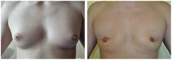 Liposukcja laserowa - ginekomastia przed i po zabiegu