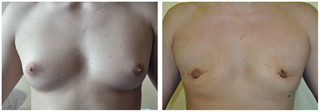 Liposukcja laserowa LAL przed i po zabiegu