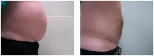 Liposukcja - odsysanie tłuszczu przed i po zabiegu