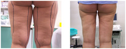 Liposukcja ultradźwiękowa Vaser Lipo przed i po zabiegu
