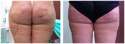 Liposukcja ultradźwiękowa Vaser Lipo przed i po zabiegu