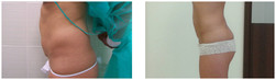 Liposukcja ultradźwiękowa Vaser Lipo przed i po zabiegu