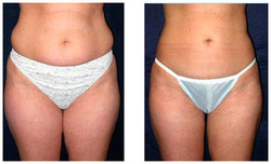 Liposukcja ultradźwiękowa Vaser Lipo przed i po zabiegu