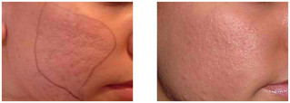 Mezoterapia frakcyjna Dermapen przed i po zabiegu
